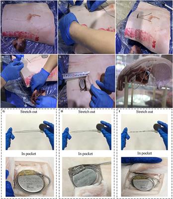 An in vitro Evaluation of the Effect of Transient Electromagnetic Fields on Pacemakers and Clinical Mitigation Measures